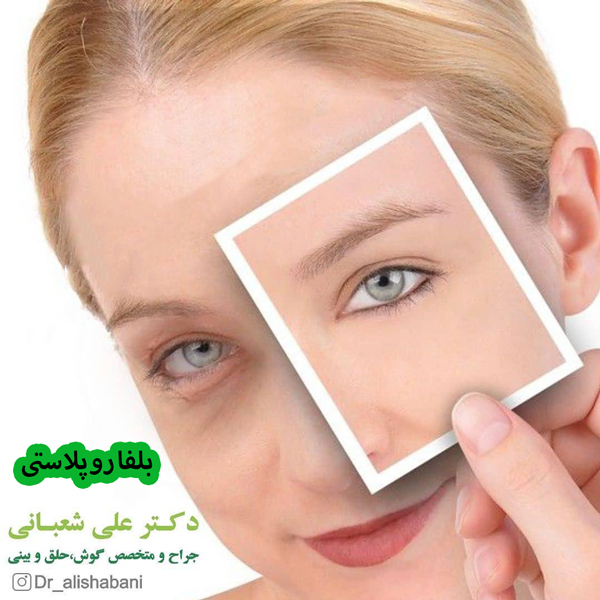 بلفاروپلاستی