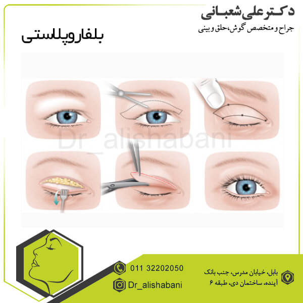 بلفاروپلاستی