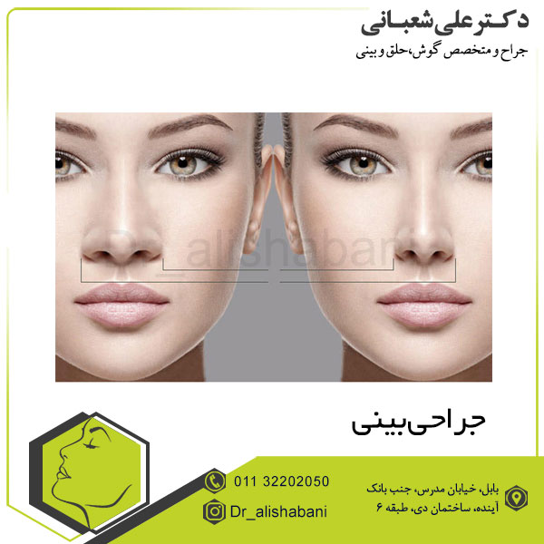 جراحی بینی
