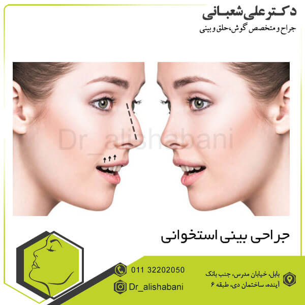 جراحی بینی استخوانی