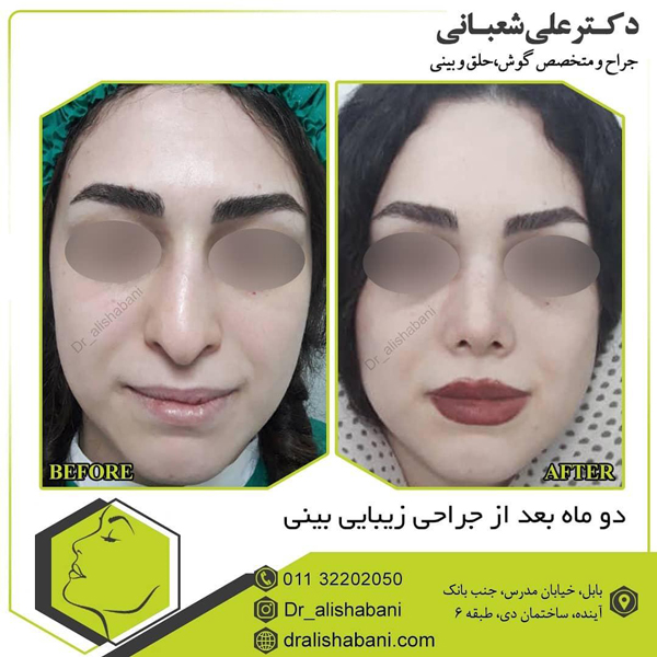 جراحی بینی بابل