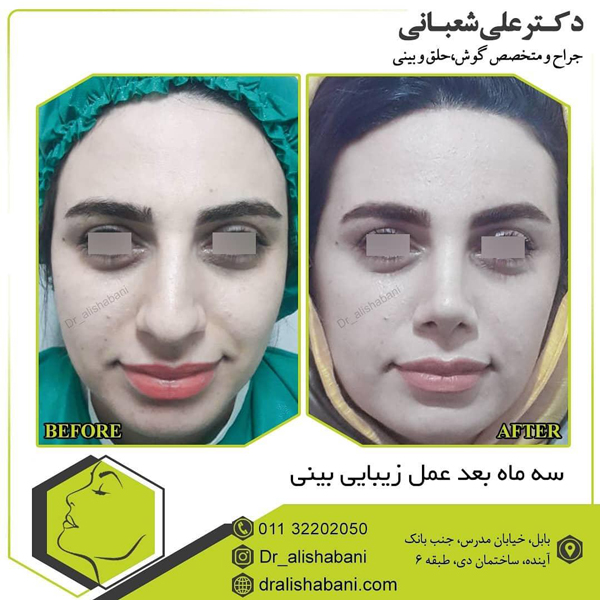 جراحی بینی فانتزی