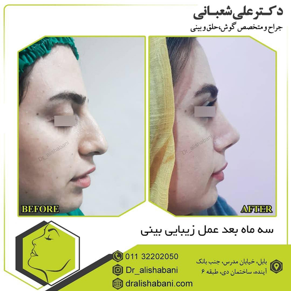 جراحی بینی فانتزی