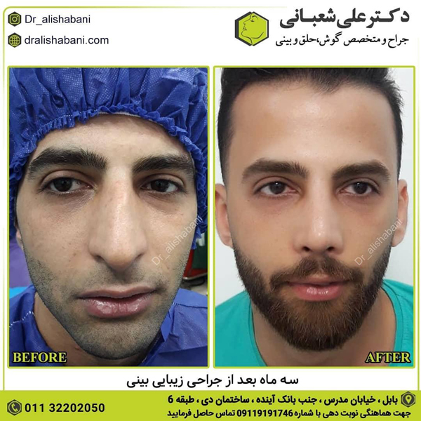 اقدامات قبل از جراحی بینی