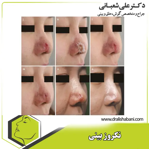 عکس نکروز بینی _ دکتر علی شعبانی