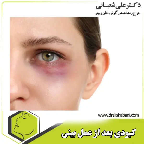 رفع کبودی بعد از عمل بینی _ دکتر علی شعبانی