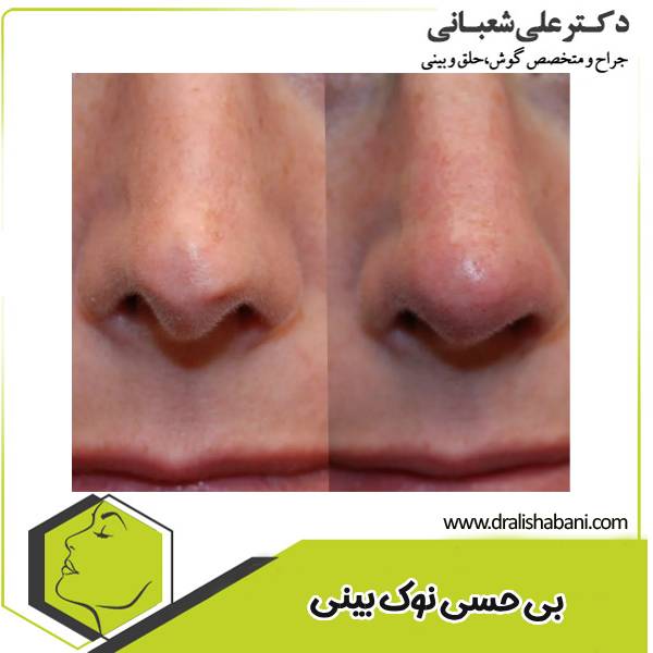 بی حسی نوک بینی بعد از جراحی