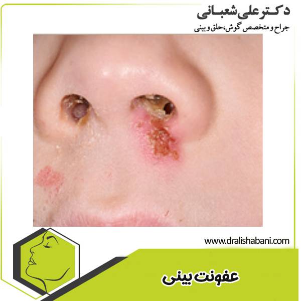عفونت بعد از جراحی بینی