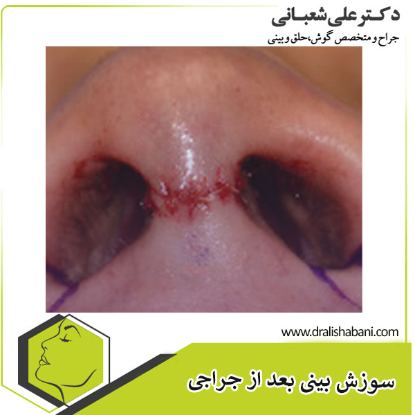 سوزش بینی بعد از جراحی