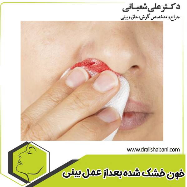 خون خشک شده بعد از عمل بینی