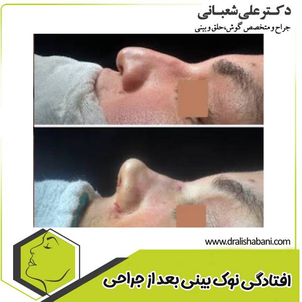 افتادگی نوک بینی بعد از عمل
