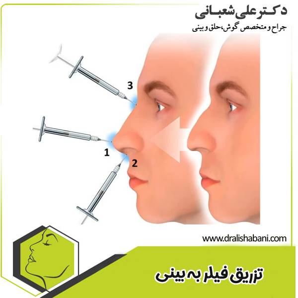 تزریق فیلر بینی