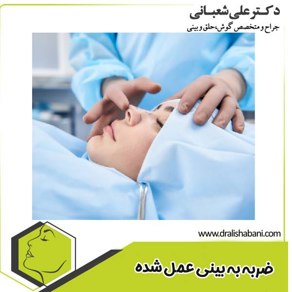 ضربه به بینی عمل شده