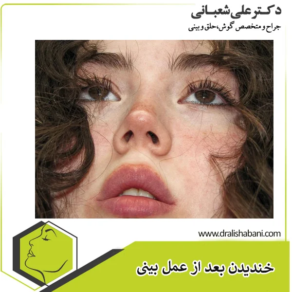 خط کانتور در عمل بینی - دکتر علی شعبانی