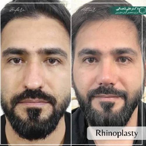 489جراحی-بینی-در-بابل