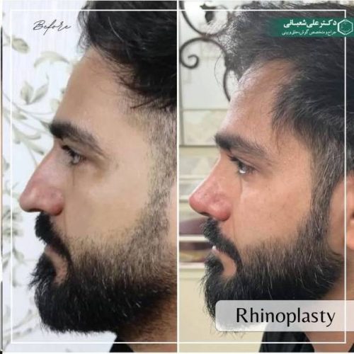 490جراحی-بینی-در-بابل