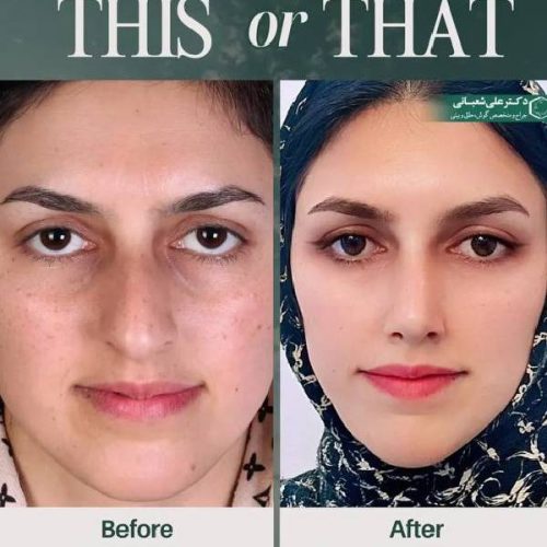 500جراحی-بینی-در-بابل