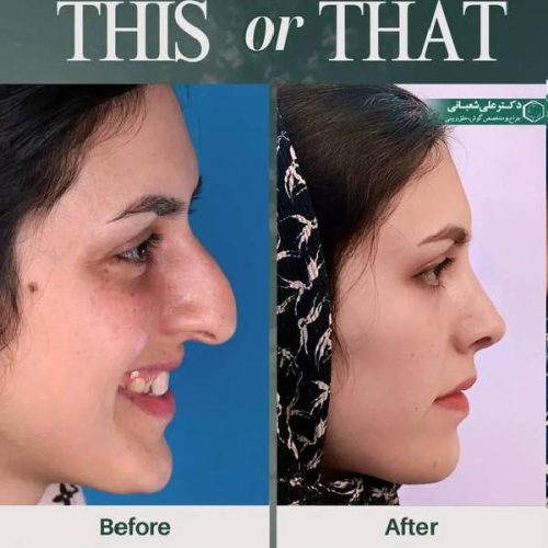 501جراحی-بینی-در-بابل