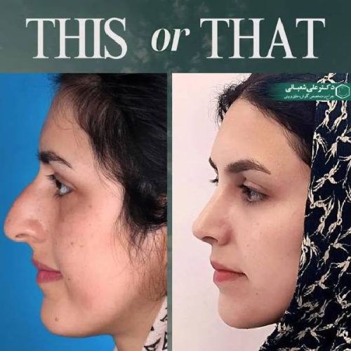 502جراحی-بینی-در-بابل