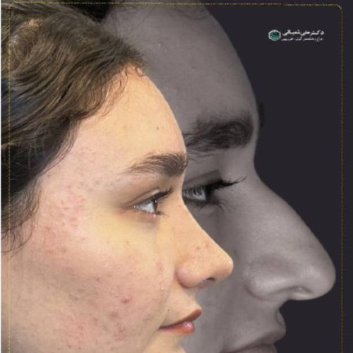 503جراحی-بینی-در-بابل