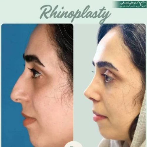 509جراحی-بینی-در-بابل