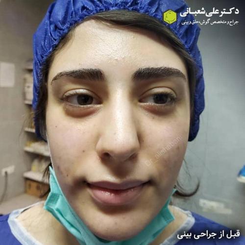 جراحی-بینی-در-بابل-114