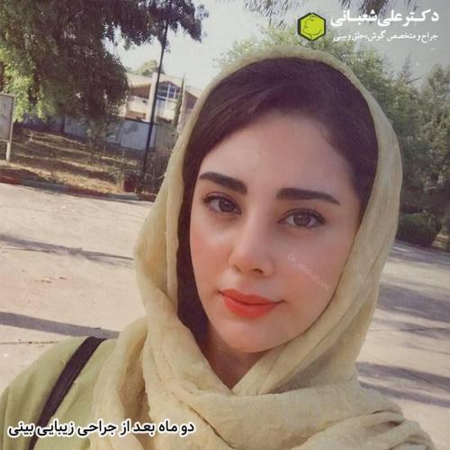 جراحی-بینی-در-بابل-115