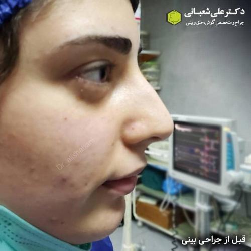 جراحی-بینی-در-بابل-116