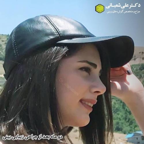 جراحی-بینی-در-بابل-117