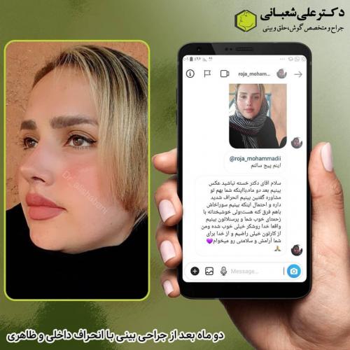 جراحی-بینی-در-بابل-118