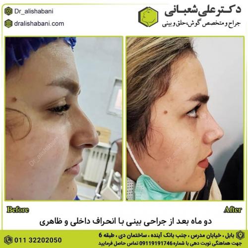 جراحی-بینی-در-بابل-119