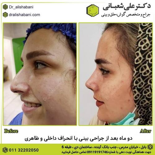 جراحی-بینی-در-بابل-120
