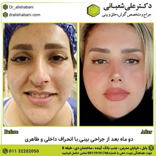 جراحی-بینی-در-بابل-121