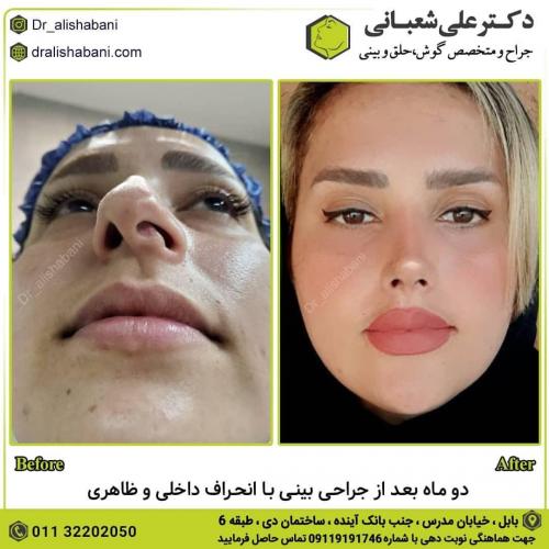 جراحی-بینی-در-بابل-122