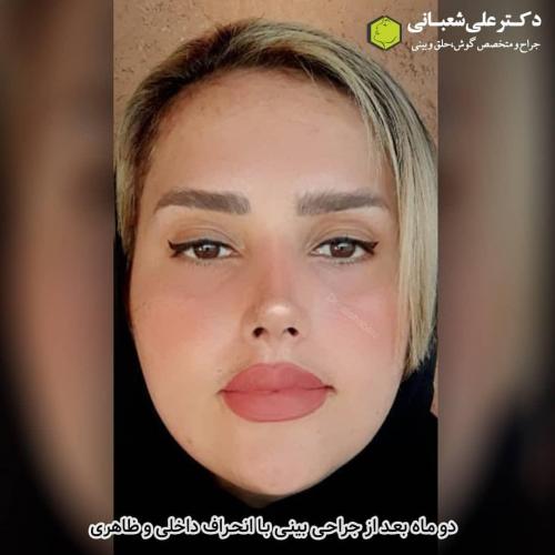 جراحی-بینی-در-بابل-123