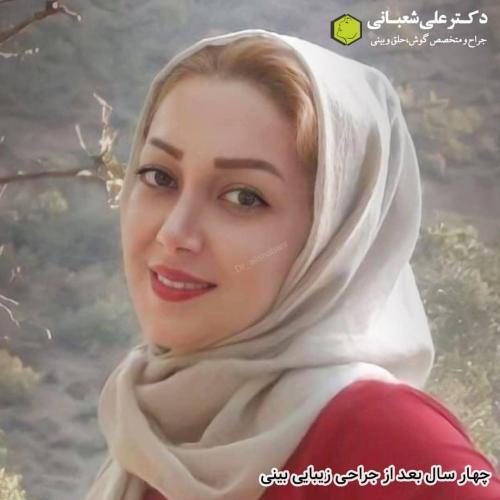 جراحی-بینی-در-بابل-125