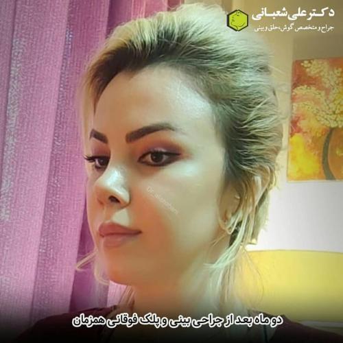 جراحی-بینی-در-بابل-126