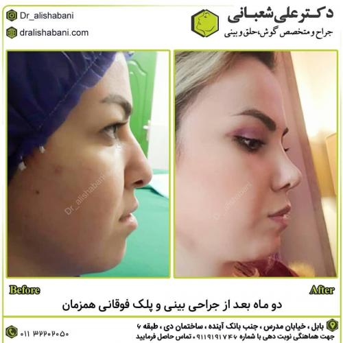 جراحی-بینی-در-بابل-127