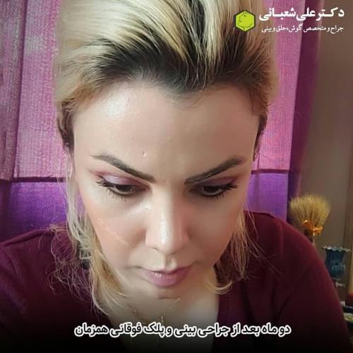 جراحی-بینی-در-بابل-128