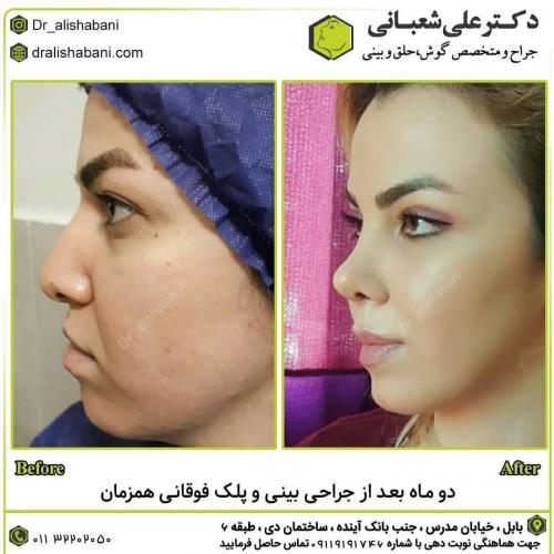 جراحی-بینی-در-بابل-129