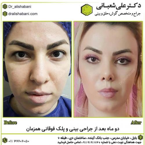 جراحی-بینی-در-بابل-130