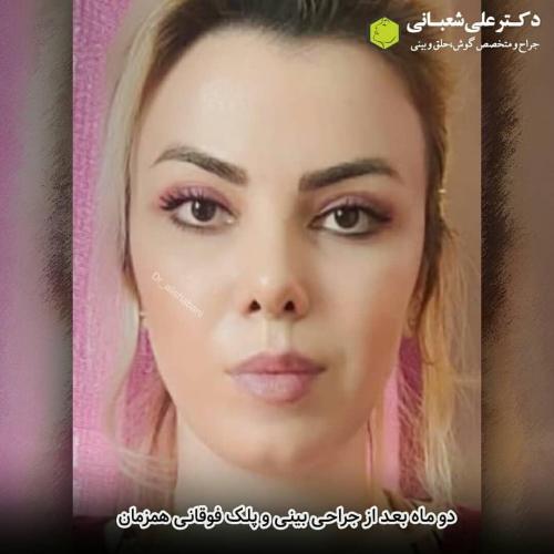 جراحی-بینی-در-بابل-131