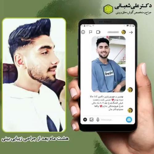 جراحی-بینی-در-بابل-132