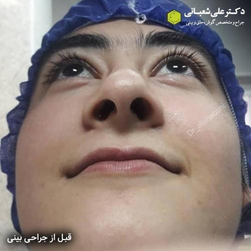 جراحی-بینی-در-بابل-133