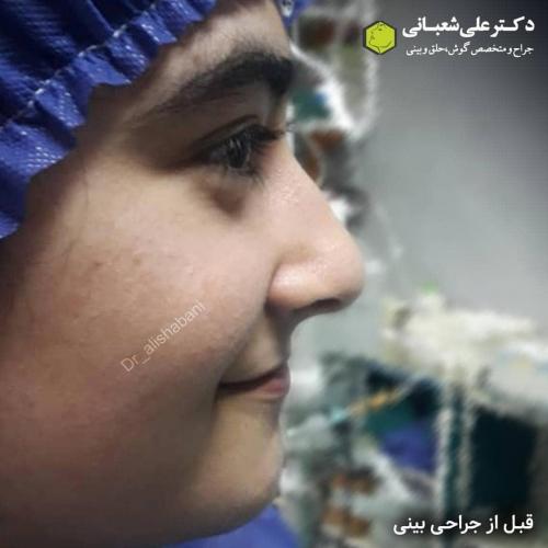 جراحی-بینی-در-بابل-134