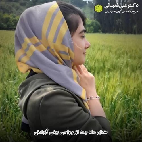 جراحی-بینی-در-بابل-135