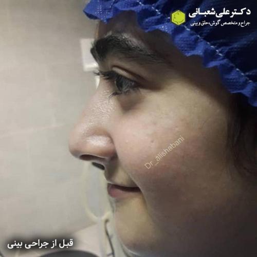 جراحی-بینی-در-بابل-136