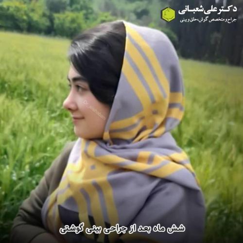 جراحی-بینی-در-بابل-137