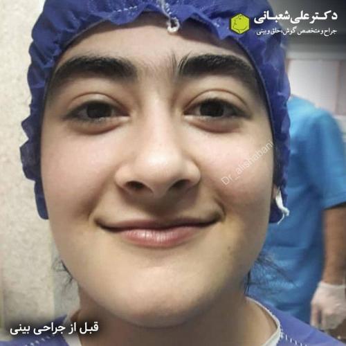 جراحی-بینی-در-بابل-138