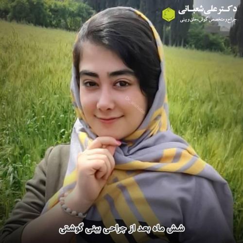 جراحی-بینی-در-بابل-139